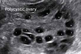 polycystic ovary